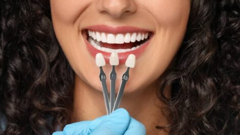 Porcelain Veneers in Miami