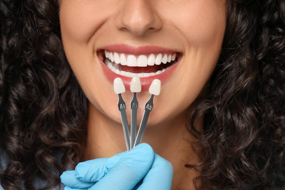 Porcelain Veneers in Miami