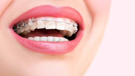 six-month smile braces