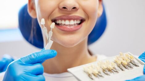 porcelain veneers Miami