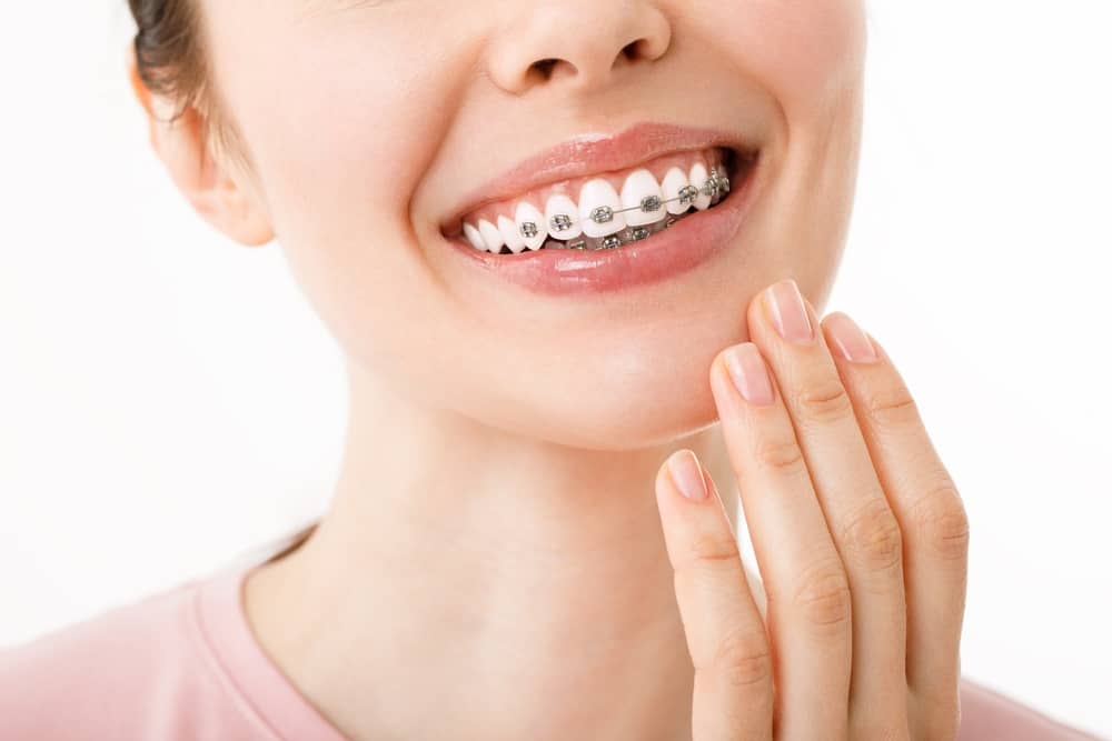 6 month braces Miami fl